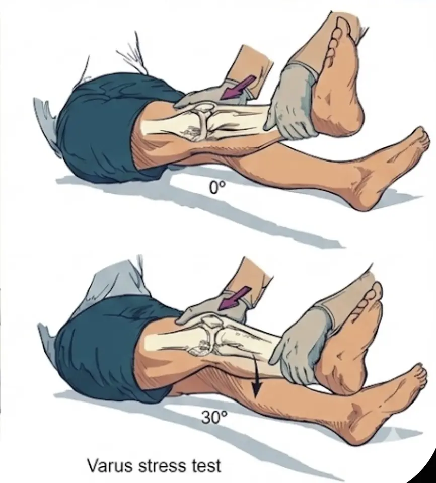 Varus Stress Test (Knee) Orthopedic Special Test